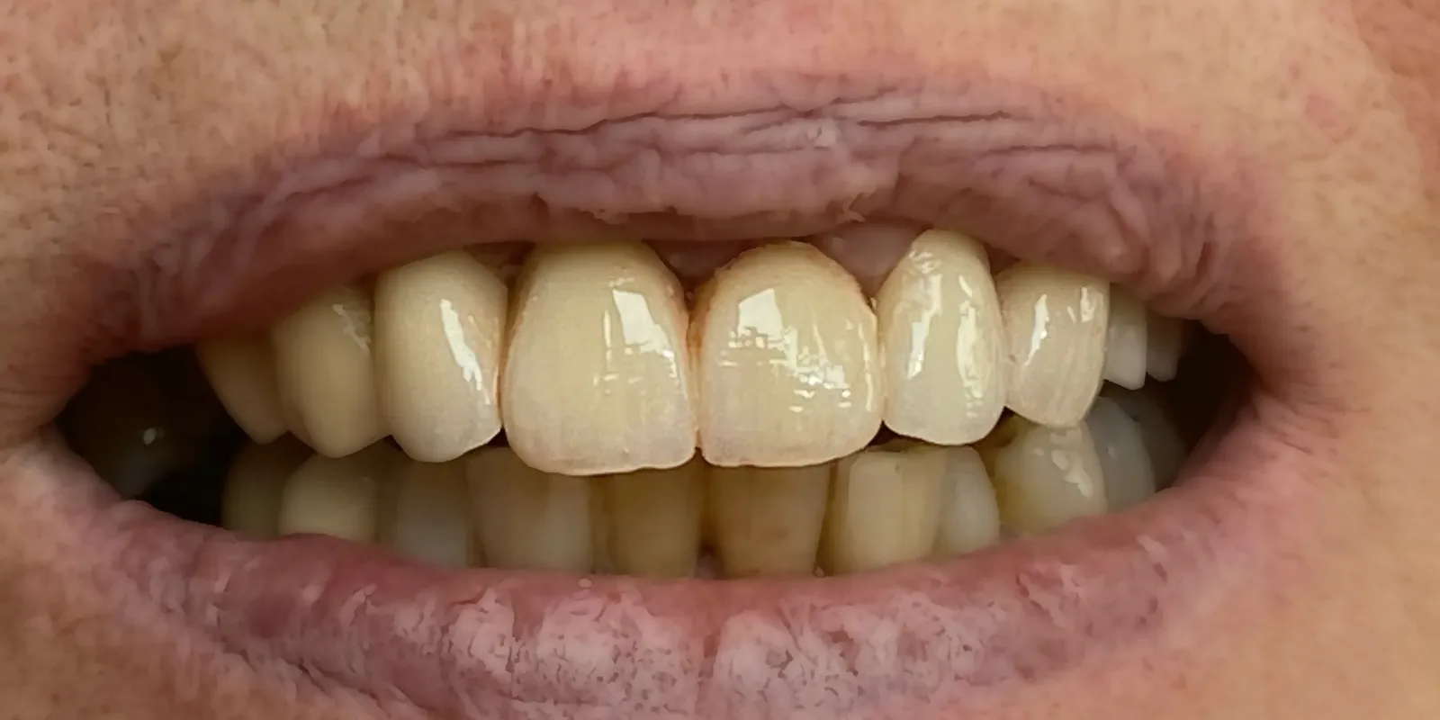 Sourire avec bridge antérieur céramique réalisé par le laboratoire ElfaProDent, vue en bouche